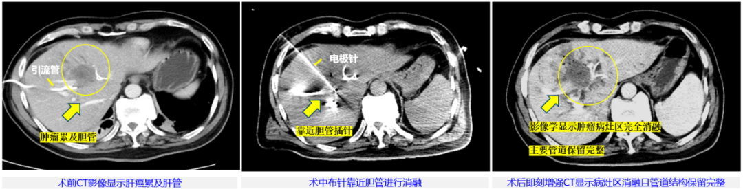 20230418-首例“微纳刀”2-医院供稿-医院供稿.png