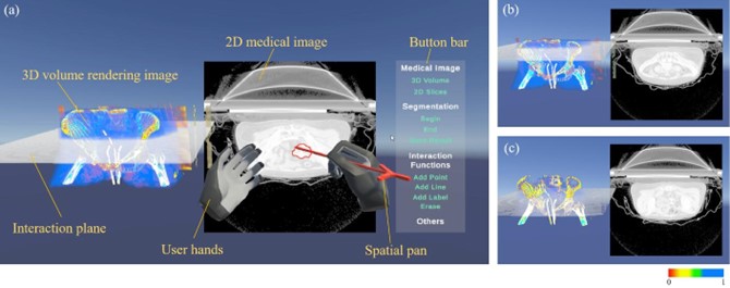 20230521-清华大学医学院博士生张楠、杨讷与李阳曦在中国生物医学工程大会暨创新医疗峰会上获奖-张楠-基于三维空间交互的宫颈癌靶区勾画虚拟现实环境总览.jpg